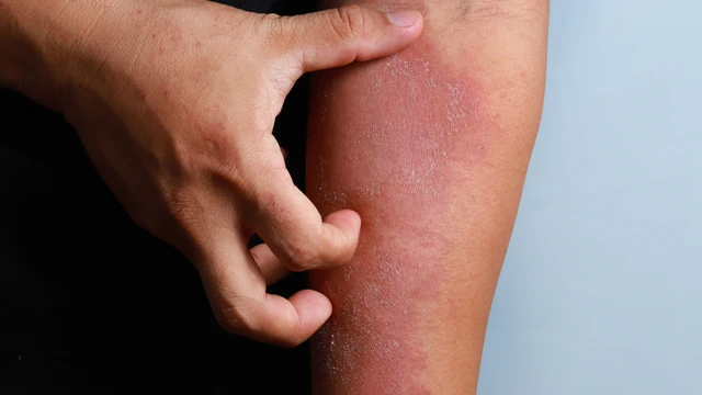 bai-viet/bong-hoa-chat-la-tinh-trang-gi-bi-bong-hoa-chat-phai-lam-sao.html