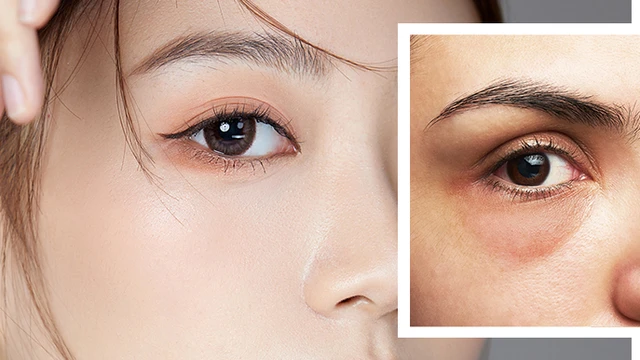 bai-viet/bong-mat-va-quang-tham-nguyen-nhan-va-cach-xu-ly.html