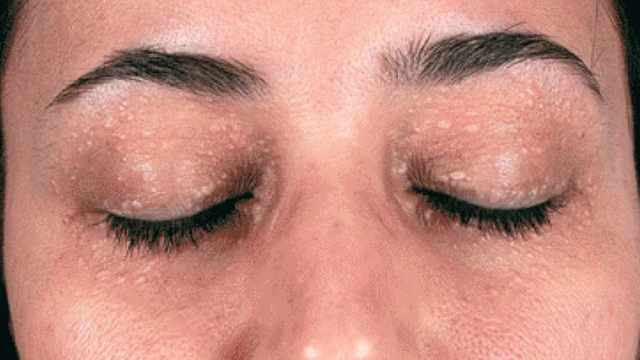 bai-viet/bong-mat-xuat-hien-mun-thit-phai-lam-sao-63105.html