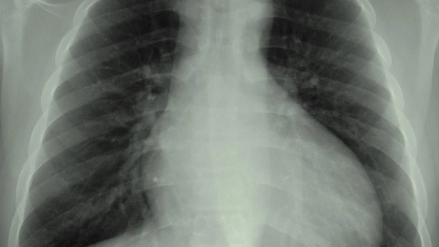 bai-viet/the-nao-la-bong-tim-to-tren-x-quang-nguyen-nhan-va-bien-phap-cai-thien.html