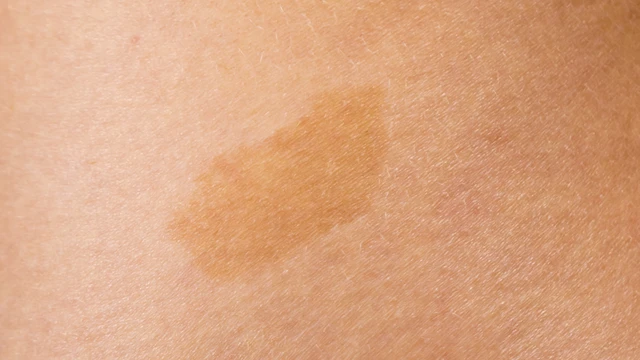 bai-viet/bot-ca-phe-sua-la-gi-nguyen-nhan-va-cach-dieu-tri-bot-ca-phe-sua.html