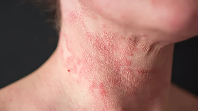 bai-viet/tim-hieu-ve-bot-multidex-deroyal-ho-tro-dieu-tri-nhiem-trung-viem-loet-da.html