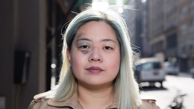 bai-viet/bot-ota-la-gi-dac-diem-lam-sang-phuong-phap-chan-doan-va-dieu-tri-bot-ota.html