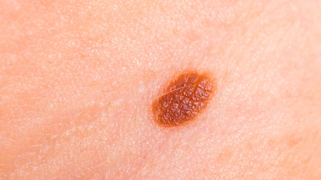 bai-viet/bot-sui-thuong-bi-nguyen-nhan-va-phuong-phap-dieu-tri.html