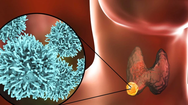 bai-viet/buou-co-dang-keo-la-gi-trieu-chung-va-dieu-tri-buou-co-dang-keo-57363.html