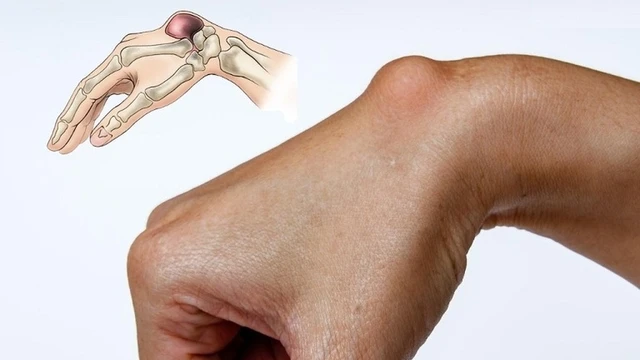 benh/buou-hoat-dich-co-tay.html