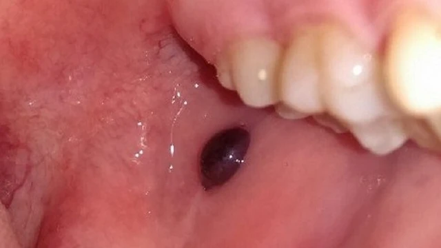 bai-viet/buou-mau-trong-mieng-nguyen-nhan-bieu-hien-va-cac-phuong-phap-dieu-tri.html