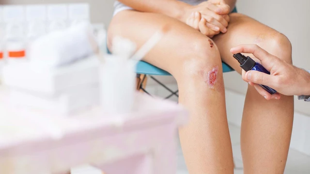 bai-viet/cac-buoc-xu-ly-vet-thuong-te-xe-tray-chan-nu-dung-cach-71736.html