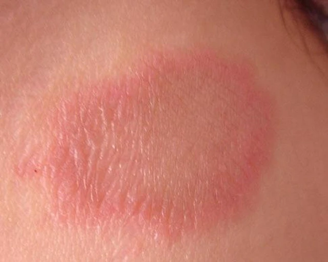 bai-viet/cac-cach-phong-chong-benh-vay-nen-hieu-qua-nhat-35740.html