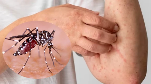 bai-viet/cac-dau-hieu-benh-sot-xuat-huyet-can-biet-de-xu-tri-kip-thoi.html