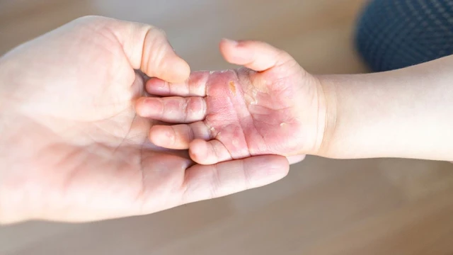 bai-viet/cac-khac-phuc-vet-bong-voi-kem-dac-tri-hyalo4-plus.html