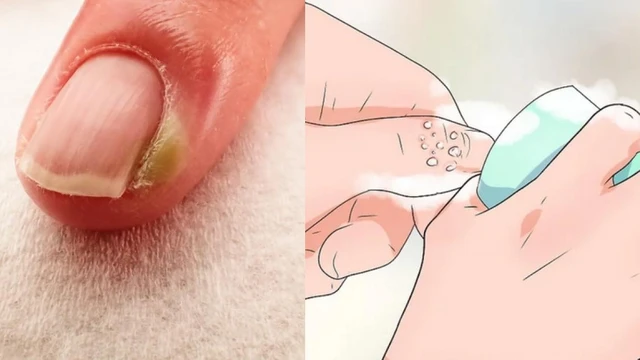 bai-viet/cac-loai-thuoc-mo-boi-chin-me-ho-tro-dieu-tri-chin-me-hieu-qua-70392.html