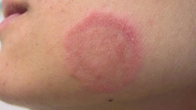 bai-viet/cac-loai-thuoc-tri-hac-lao-o-mat-hieu-qua-55458.html