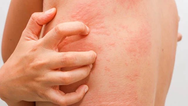 bai-viet/cac-loai-thuoc-tri-me-day-hieu-qua-nhat-hien-nay.html