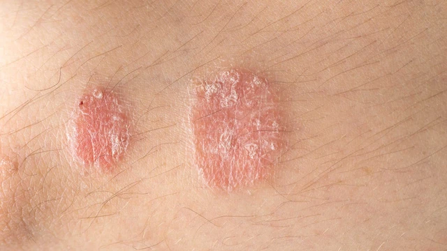 bai-viet/cac-loai-thuoc-tri-vay-nen-cua-my-pho-bien-va-luu-y-khi-su-dung-thuoc.html