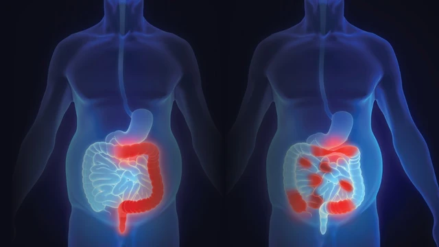 bai-viet/cac-phuong-phap-dieu-tri-viem-ruot-hien-nay-va-cach-phong-ngua.html