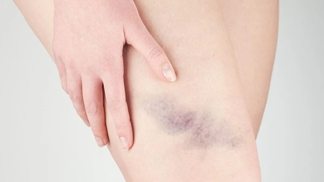 bai-viet/cac-phuong-phap-lam-tan-mau-bam-hieu-qua-tai-nha-68876.html