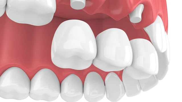 bai-viet/cac-phuong-phap-trong-rang-hieu-qua-nhat-hien-nay.html