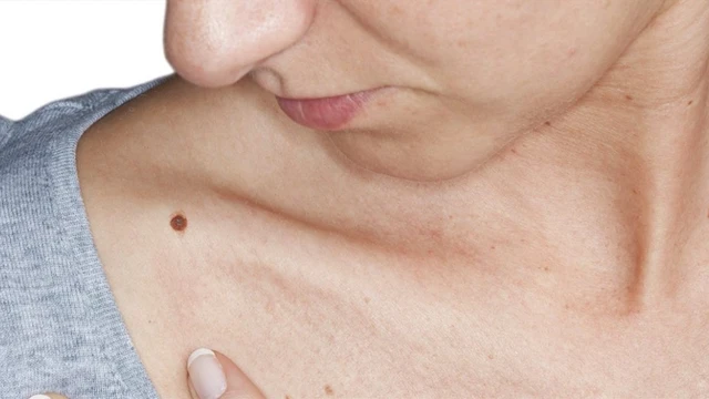 bai-viet/cac-phuong-phap-xoa-not-ruoi-60829.html