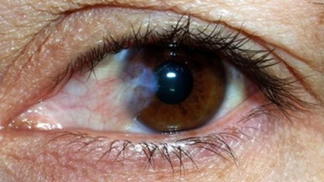 bai-viet/cac-trieu-chung-cua-rach-vong-mac-la-gi.html