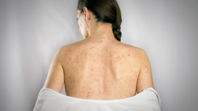 bai-viet/cac-vi-tri-nhiem-benh-zona-than-kinh.html