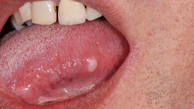 bai-viet/cac-yeu-to-nguy-co-cua-ung-thu-luoi-ma-ban-rat-hay-bo-qua.html