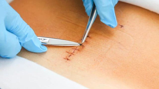 bai-viet/cach-cat-chi-vet-thuong-va-dau-hieu-cho-thay-vet-thuong-da-lanh.html