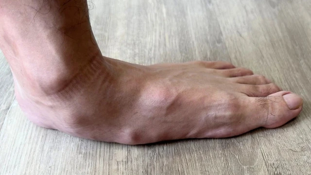 bai-viet/cach-chua-ban-chan-bet-o-nguoi-lon-va-mot-so-bien-chung-co-the-gap.html