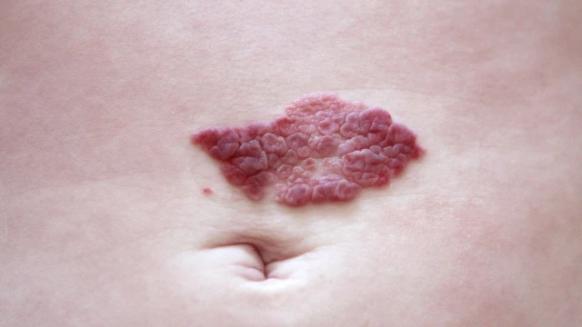 bai-viet/cach-chua-benh-u-mau-o-nguoi-lon-khi-nao-can-can-thiep-va-lua-chon-dieu-tri-phu-hop.html