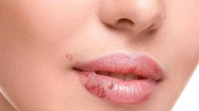 bai-viet/cach-chua-choc-mep-don-gian-ai-cung-lam-duoc-62130.html