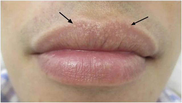 bai-viet/nguyen-nhan-va-cach-chua-dom-trang-tren-moi.html