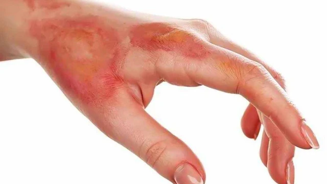 bai-viet/cach-chua-lanh-seo-bong-hieu-qua-nhat-60655.html