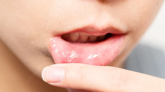 bai-viet/cach-chua-nhiet-mieng-tai-nha-hieu-qua-co-the-ban-chua-biet.html