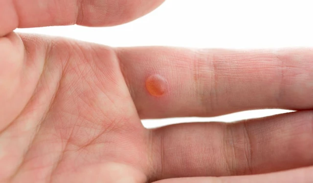 bai-viet/cach-chua-noi-mun-nuoc-o-tay-nhu-the-nao-cho-hieu-qua-58312.html