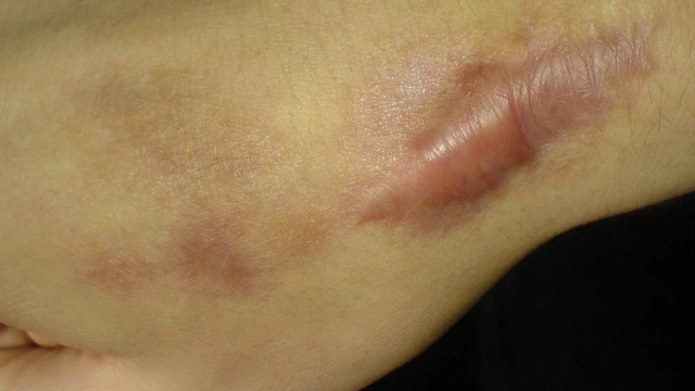 bai-viet/cach-chua-seo-loi-ngua-hieu-qua-54774.html