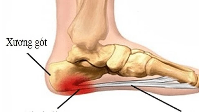 bai-viet/cach-chua-viem-can-gan-ban-chan-bang-phuong-phap-huyet-tuong-giau-tieu-cau-prp-56588.html