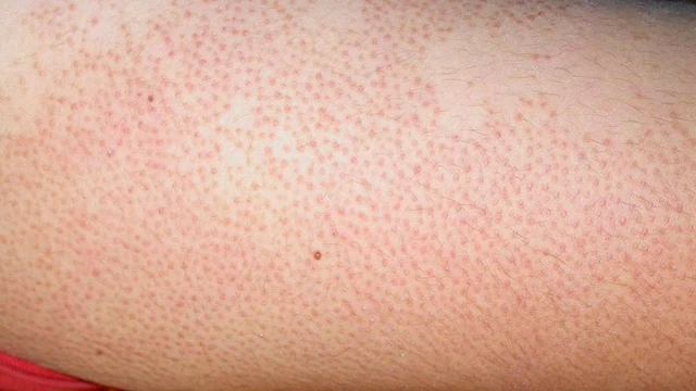 bai-viet/cach-dieu-tri-benh-me-day-phong-nhiet-va-cach-phong-tranh-54731.html