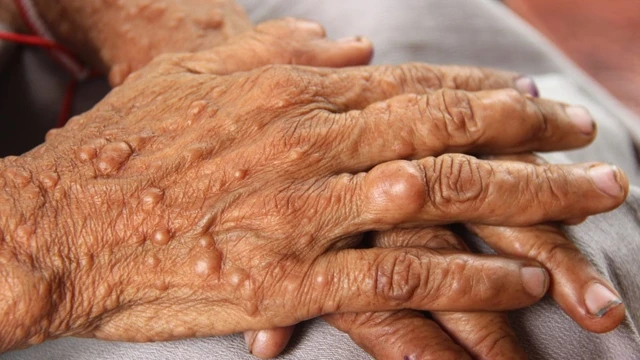 bai-viet/cach-dieu-tri-benh-u-xo-than-kinh-va-mot-so-thong-tin-ve-benh-ban-can-biet.html