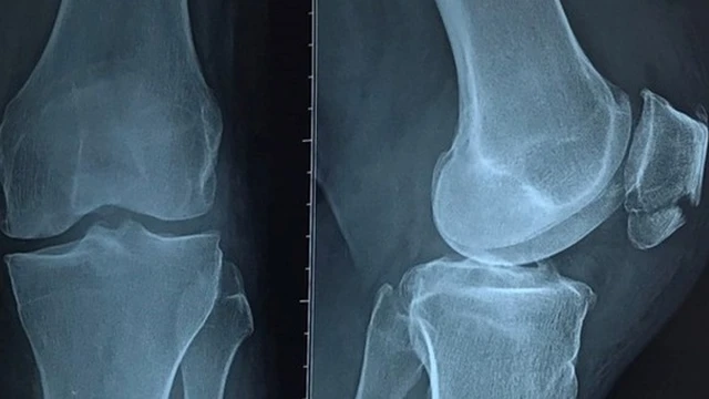 bai-viet/cach-dieu-tri-chan-thuong-gay-xuong-banh-che-do-bac-si-goi-y-54984.html