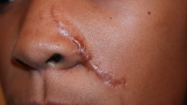 bai-viet/cach-dieu-tri-seo-loi-tren-mat-hieu-qua-56280.html