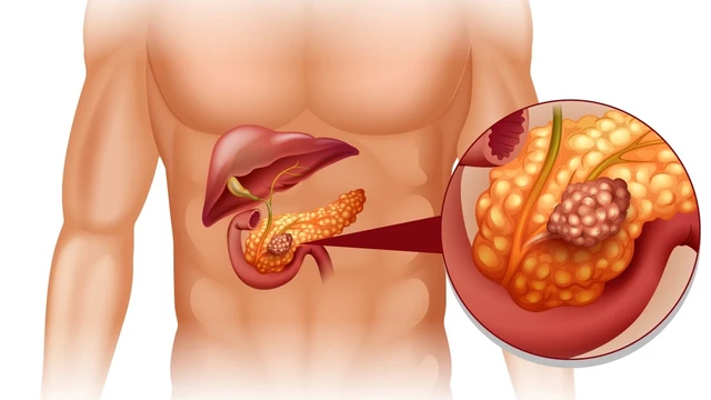 bai-viet/cach-dieu-tri-ung-thu-tuyen-tuy-va-mot-so-tac-dung-phu-co-the-gap-phai.html