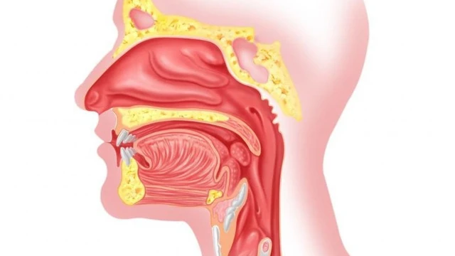 bai-viet/cach-dieu-tri-va-cham-soc-cho-nguoi-bi-viem-mui-hong-56048.html
