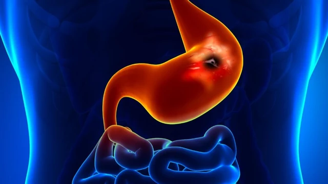 bai-viet/cach-dieu-tri-viem-loet-da-day-hieu-qua-ma-ban-nen-biet.html