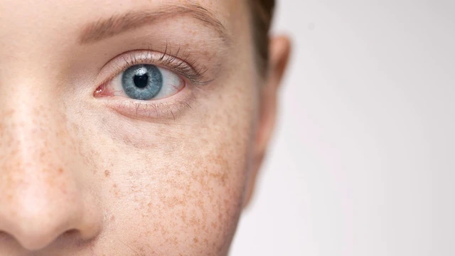 bai-viet/cach-don-gian-nhat-de-giam-tham-nam-va-tan-nhang-la-gi.html