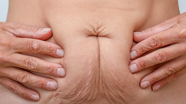 bai-viet/cach-giam-mo-bung-sau-sinh-hieu-qua-ma-me-bim-can-biet.html