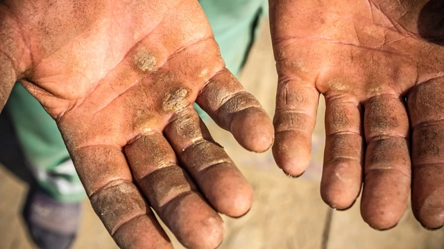 bai-viet/bat-mi-cach-lam-het-vet-chai-o-ngon-tay.html