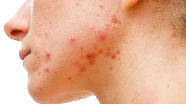 bai-viet/cach-lam-xep-mun-sung-do-sau-1-dem-ban-da-biet-chua.html