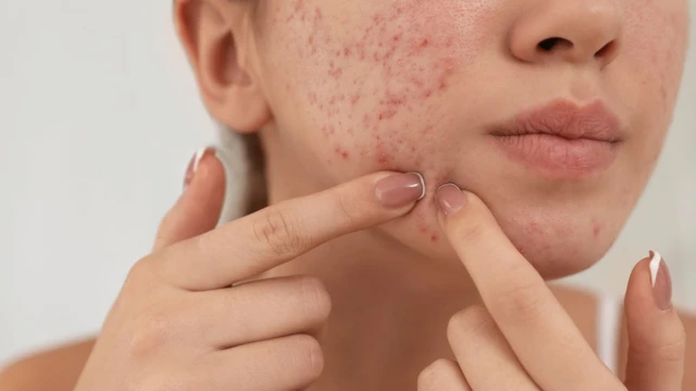 bai-viet/the-nao-la-cach-nan-mun-dung-cach-loai-mun-nao-co-the-nan.html