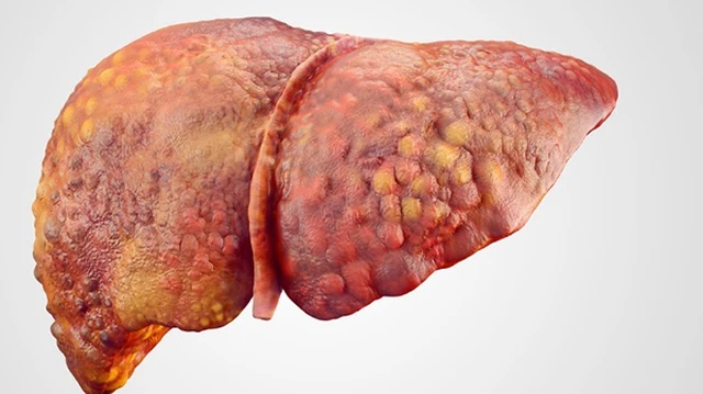 bai-viet/cach-nhan-biet-cac-dau-hieu-xo-gan-tu-som-don-gian-va-chinh-xac-nhat.html