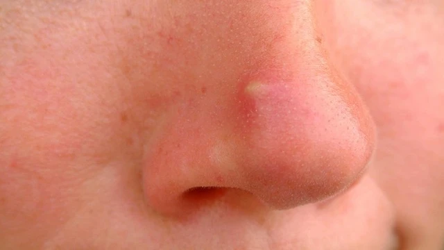 bai-viet/cach-tri-mun-boc-o-mui-khong-de-lai-tham-seo.html